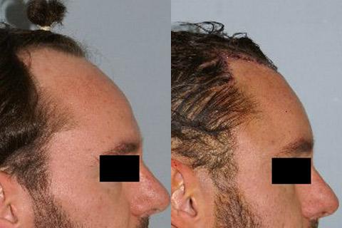 Hair Line Lowering before and after photos in San Francisco, CA, Patient 14150
