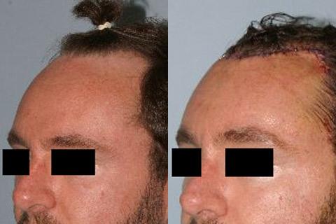 Hair Line Lowering before and after photos in San Francisco, CA, Patient 14150