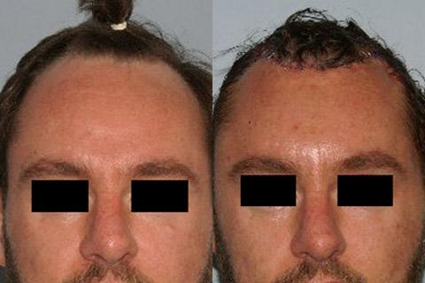 Hair Line Lowering before and after photos in San Francisco, CA, Patient 14150