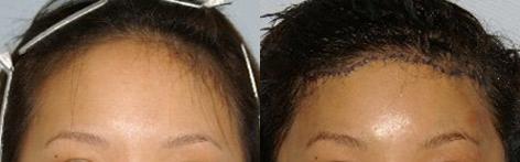 Hair Line Lowering before and after photos in San Francisco, CA, Patient 14161