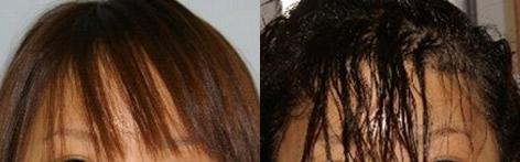 Hair Line Lowering before and after photos in San Francisco, CA, Patient 14161