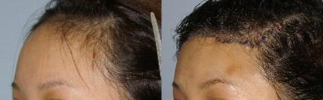 Hair Line Lowering before and after photos in San Francisco, CA, Patient 14161