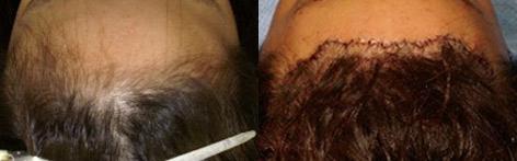 Hair Line Lowering before and after photos in San Francisco, CA, Patient 14161