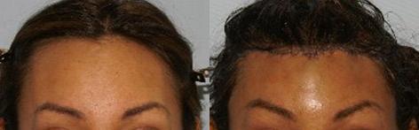 Hair Line Lowering before and after photos in San Francisco, CA, Patient 14170