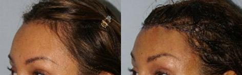 Hair Line Lowering before and after photos in San Francisco, CA, Patient 14170