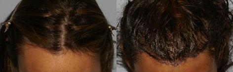 Hair Line Lowering before and after photos in San Francisco, CA, Patient 14170