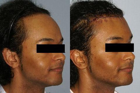 Hair Line Lowering before and after photos in San Francisco, CA, Patient 14181