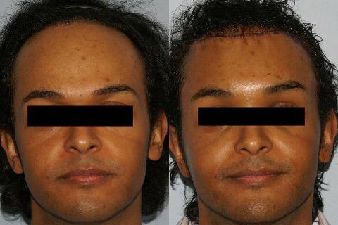 Hair Line Lowering before and after photos in San Francisco, CA, Patient 14181