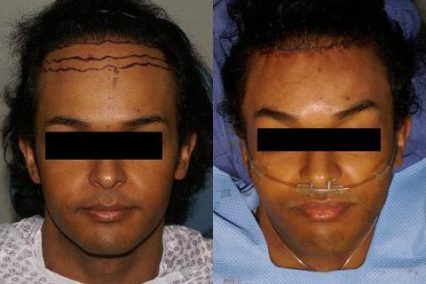 Hair Line Lowering before and after photos in San Francisco, CA, Patient 14181