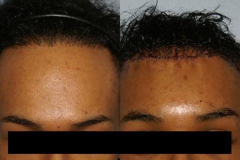 Hair Line Lowering before and after photos in San Francisco, CA, Patient 14181