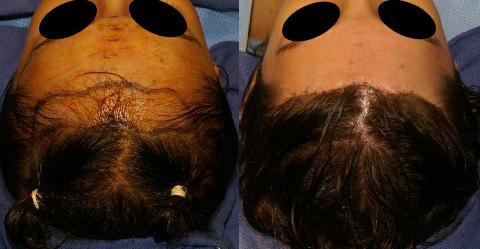 Hair Line Lowering before and after photos in San Francisco, CA, Patient 14190