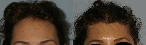 Hair Line Lowering before and after photos in San Francisco, CA, Patient 14190