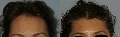 Patient 14190, Hair Line Lowering before and after photos Hair Line Lowering before and after photos in San Francisco, CA, Patient 14190