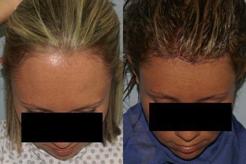 Hair Line Lowering before and after photos in San Francisco, CA, Patient 14197