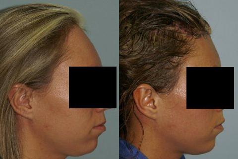 Hair Line Lowering before and after photos in San Francisco, CA, Patient 14197
