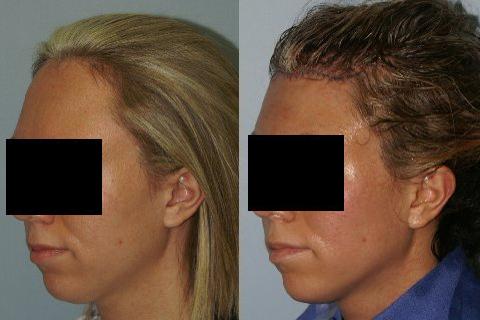 Hair Line Lowering before and after photos in San Francisco, CA, Patient 14197