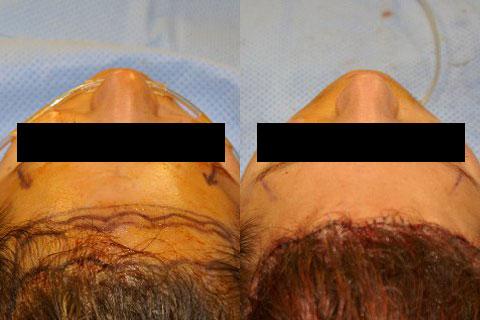 Hair Line Lowering before and after photos in San Francisco, CA, Patient 14208