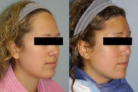 Hair Line Lowering before and after photos in San Francisco, CA, Patient 14208