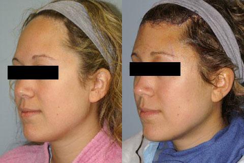 Hair Line Lowering before and after photos in San Francisco, CA, Patient 14208