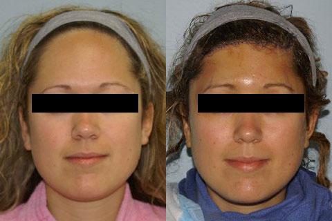Hair Line Lowering before and after photos in San Francisco, CA, Patient 14208