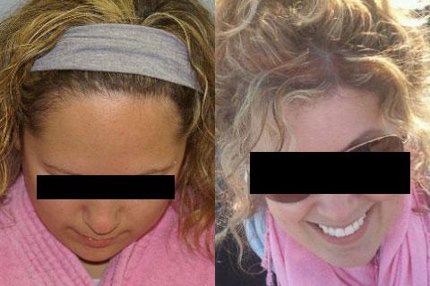 Hair Line Lowering before and after photos in San Francisco, CA, Patient 14208