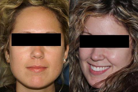 Hair Line Lowering before and after photos in San Francisco, CA, Patient 14208