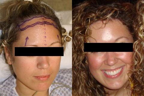 Hair Line Lowering before and after photos in San Francisco, CA, Patient 14208