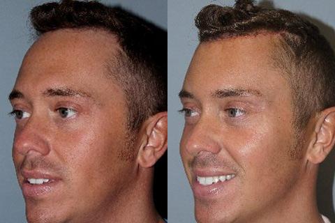 Hair Line Lowering before and after photos in San Francisco, CA, Patient 14228