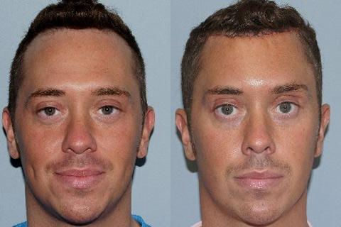 Hair Line Lowering before and after photos in San Francisco, CA, Patient 14228