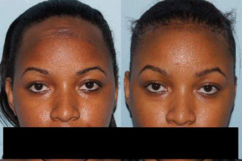 Hair Line Lowering before and after photos in San Francisco, CA, Patient 14258