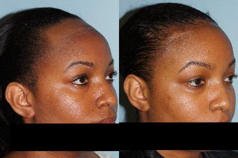 Hair Line Lowering before and after photos in San Francisco, CA, Patient 14258