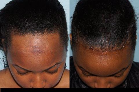 Hair Line Lowering before and after photos in San Francisco, CA, Patient 14258