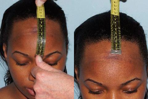 Hair Line Lowering before and after photos in San Francisco, CA, Patient 14258