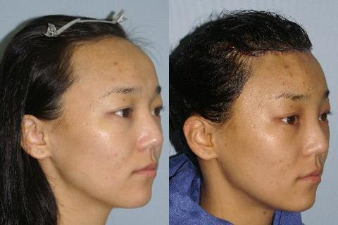 Hair Line Lowering before and after photos in San Francisco, CA, Patient 14266