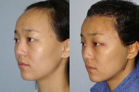 Hair Line Lowering before and after photos in San Francisco, CA, Patient 14266