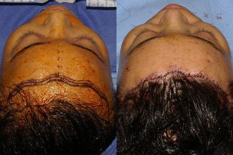 Hair Line Lowering before and after photos in San Francisco, CA, Patient 14266