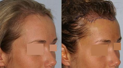 Hair Line Lowering before and after photos in San Francisco, CA, Patient 14275