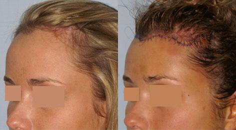 Hair Line Lowering before and after photos in San Francisco, CA, Patient 14275