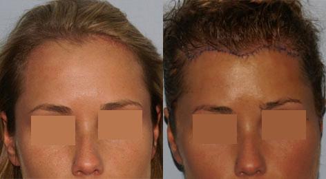 Hair Line Lowering before and after photos in San Francisco, CA, Patient 14275