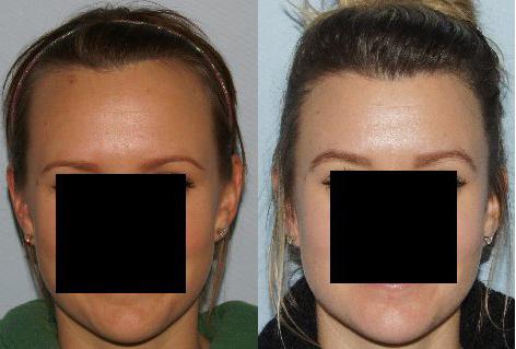 Hair Line Lowering before and after photos in San Francisco, CA, Patient 14318