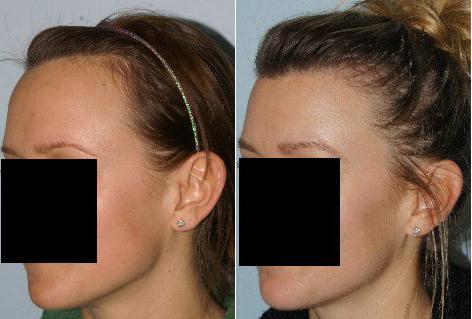 Hair Line Lowering before and after photos in San Francisco, CA, Patient 14318