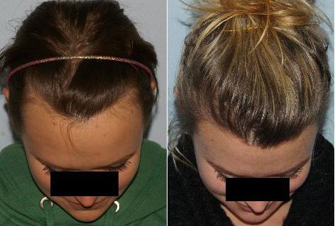 Hair Line Lowering before and after photos in San Francisco, CA, Patient 14318