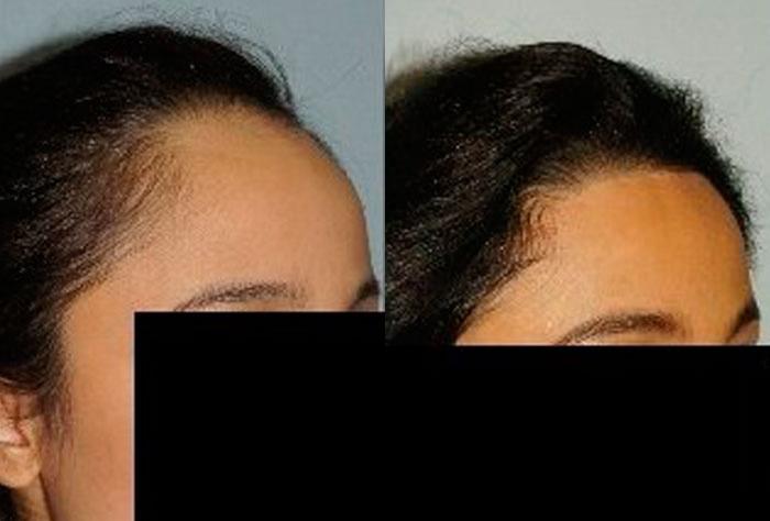 Hair Line Lowering before and after photos in San Francisco, CA, Patient 14336