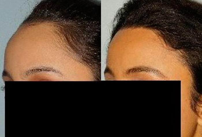 Hair Line Lowering before and after photos in San Francisco, CA, Patient 14336