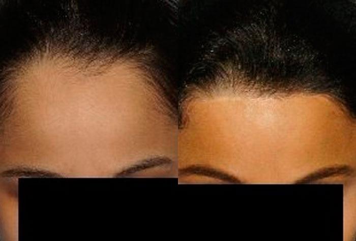 Hair Line Lowering before and after photos in San Francisco, CA, Patient 14336