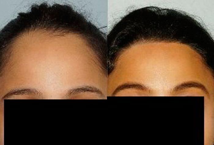 Hair Line Lowering before and after photos in San Francisco, CA, Patient 14336