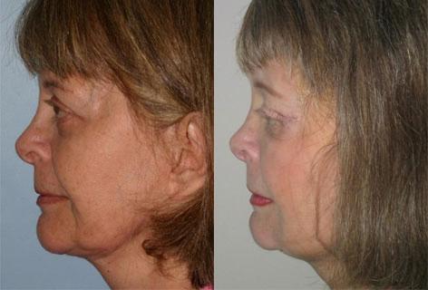 Facelift before and after photos in San Francisco, CA, Patient 14391