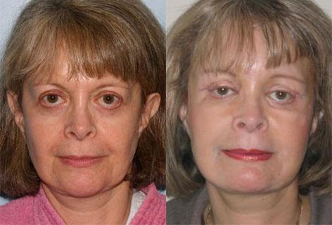 Facelift before and after photos in San Francisco, CA, Patient 14391
