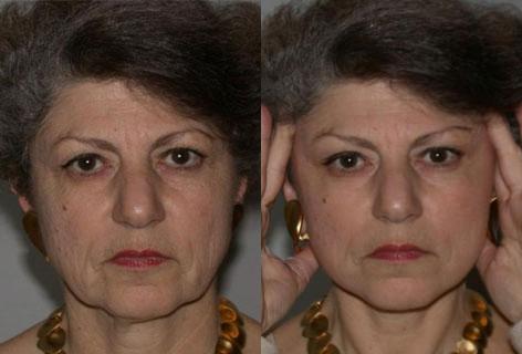 Facelift before and after photos in San Francisco, CA, Patient 14396