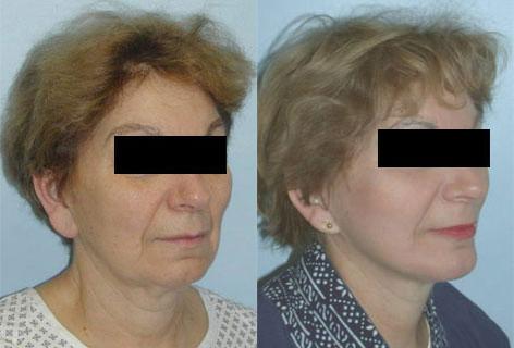 Facelift before and after photos in San Francisco, CA, Patient 14399